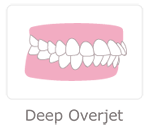 Deep Overjet