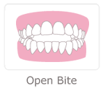 Open Bite